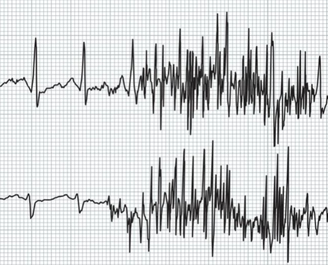 Årsag og løsning til støj på EKG